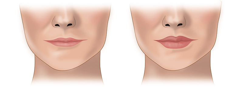 Почему контурную пластику губ и другие косметологические услуги важно доверять профессионалам