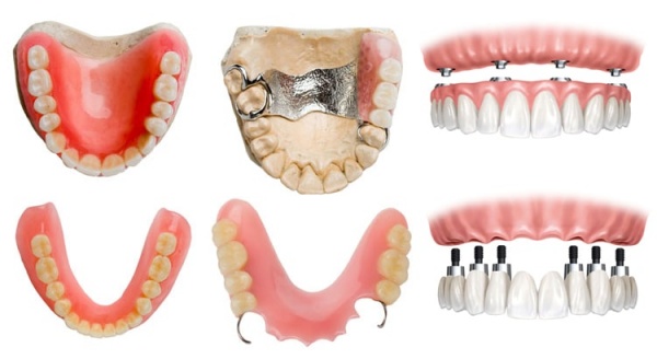 Методы зубного протезирования