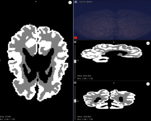 Белорусские врачи смогут точнее выявлять ДЦП у новорожденных с помощью нейросети Яндекса