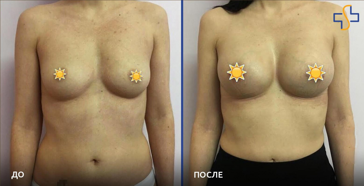 фото до и после проведённой операции по увеличению груди